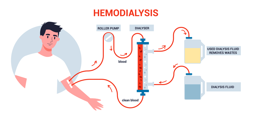 Hemodialysis Hemodialysis
